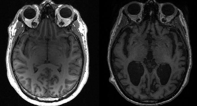 Alzheimer’s Disease: Five Things To Know